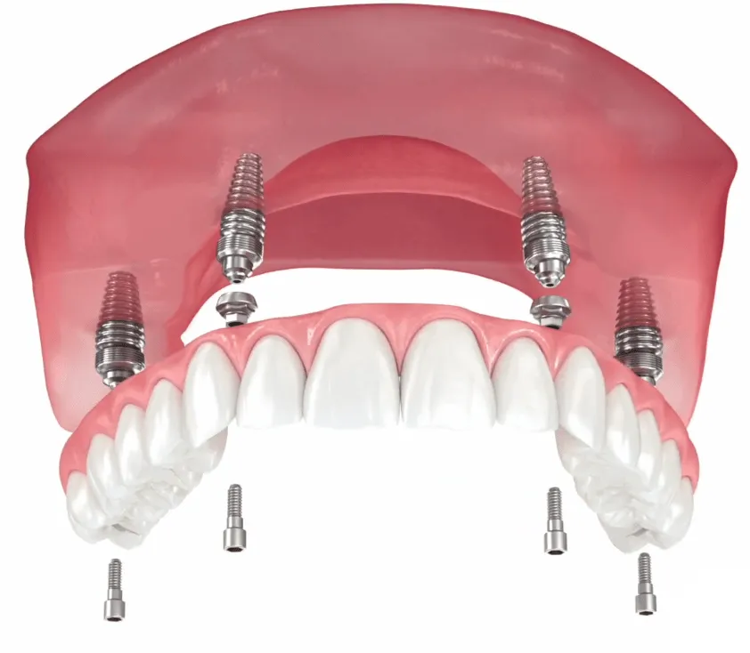 Implant Placement