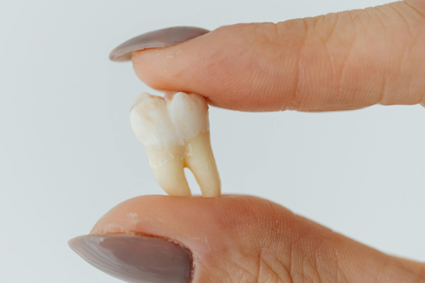 Dental Extractions Treatments