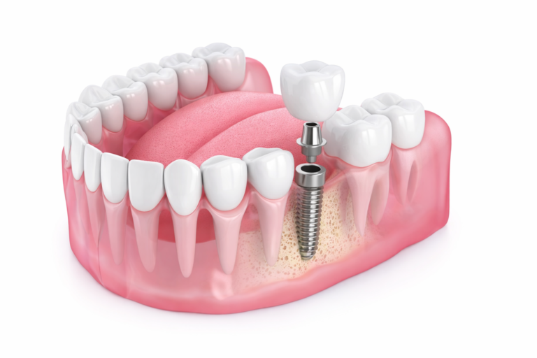 Dental implant overview