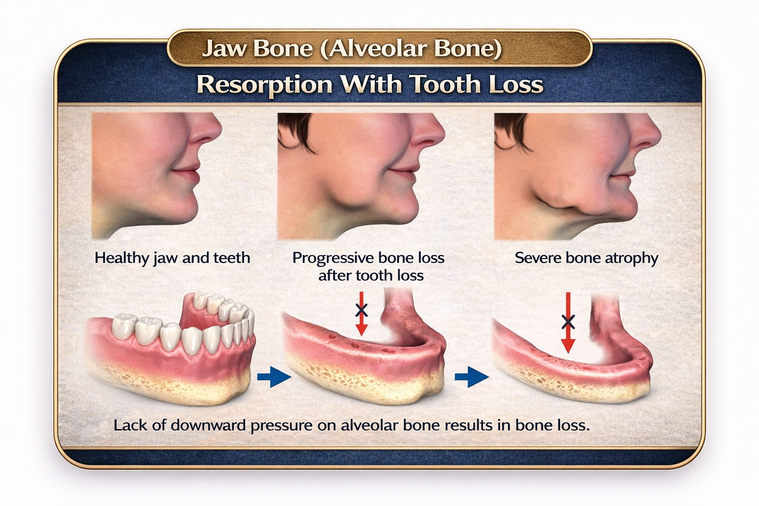 Jaw Bone (Alveolar Bone) Resorption With Tooth Loss
