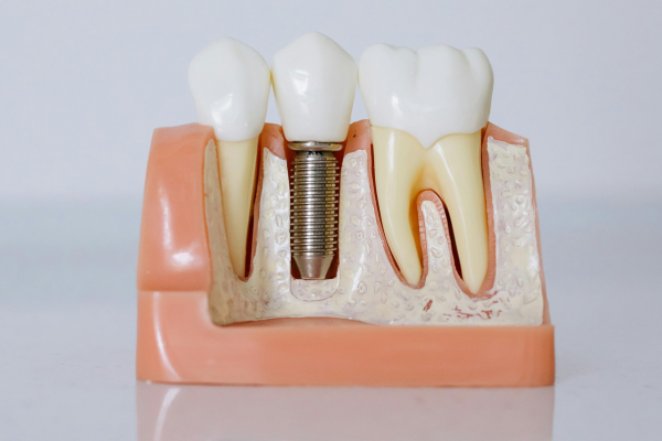 Dental Bridges Treatments