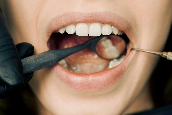 Dental Cleaning Services